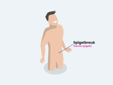 Spigelbreuk