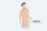 Liesbreuk