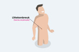 Littekenbreuk