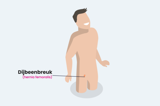 Dijbeenbreuk Hin