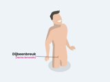 Dijbeenbreuk Hin