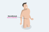 Navelbreuk